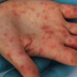Uberlândia tem nove casos confirmados de sarampo, segundo boletim epidemiológico de MG