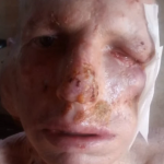 Homem com câncer de pele arrecada mais de R$ 500 mil em “vaquinha” na internet